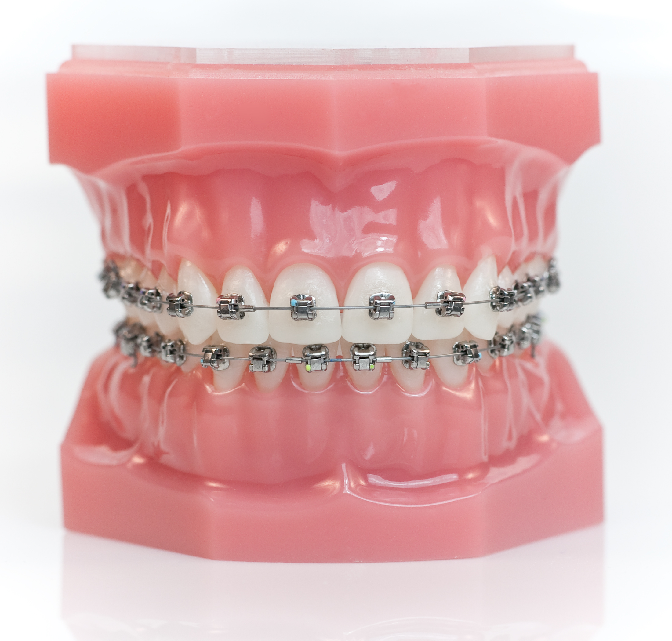 Metal Braces