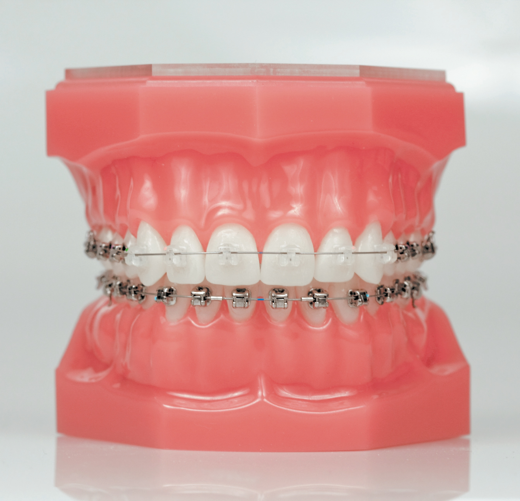 Clear Braces